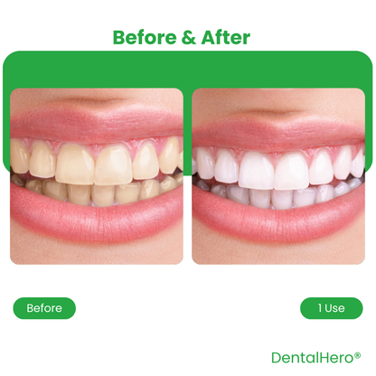 DentalHero™ U-Smart Toothbrush Kit