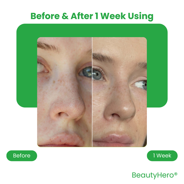 BeautyHero® Nose Pore Patches